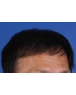 After Hair Transplant&nbsp;2 Sessions (Areas)